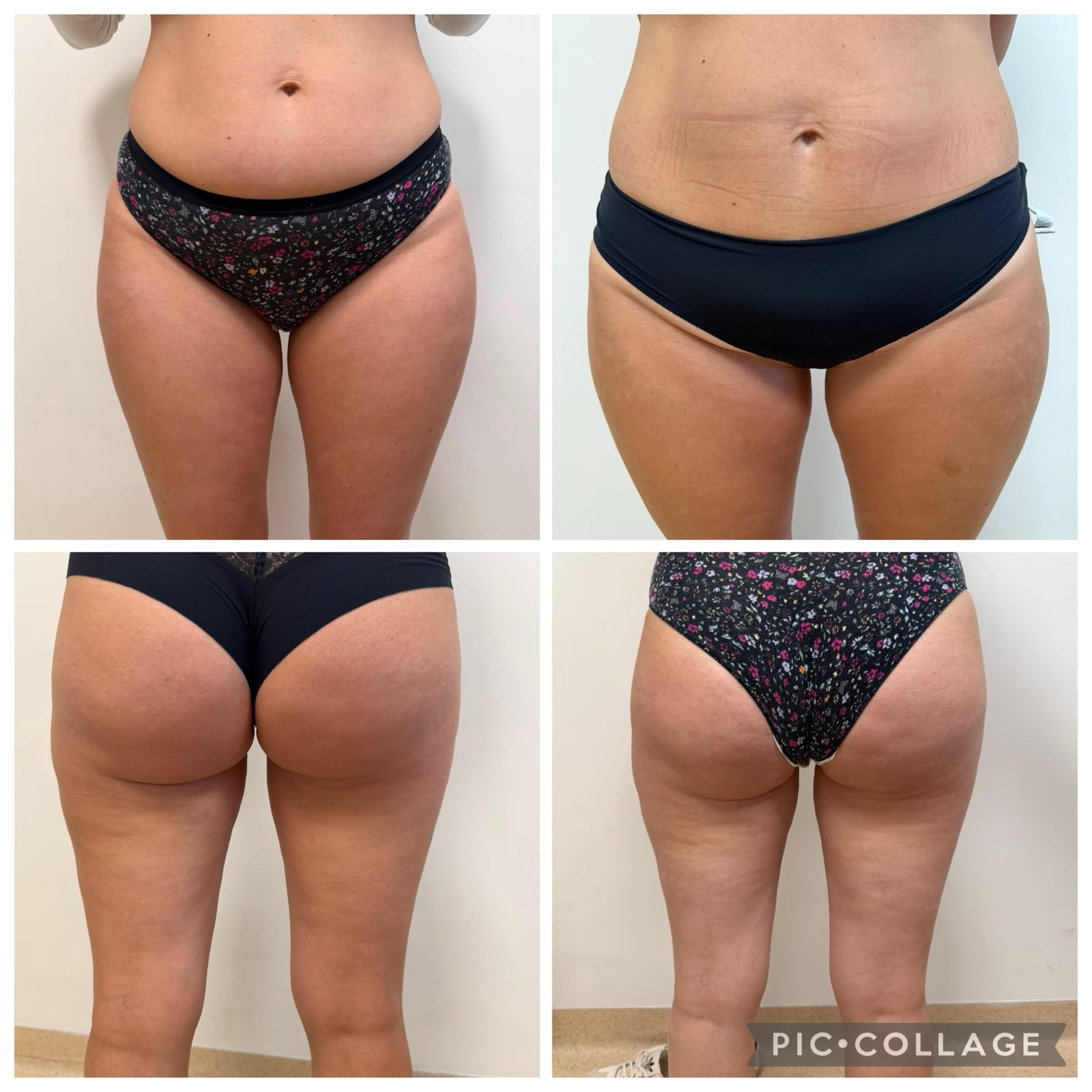 Criolipolisi addome e cosce — pre e post trattamento