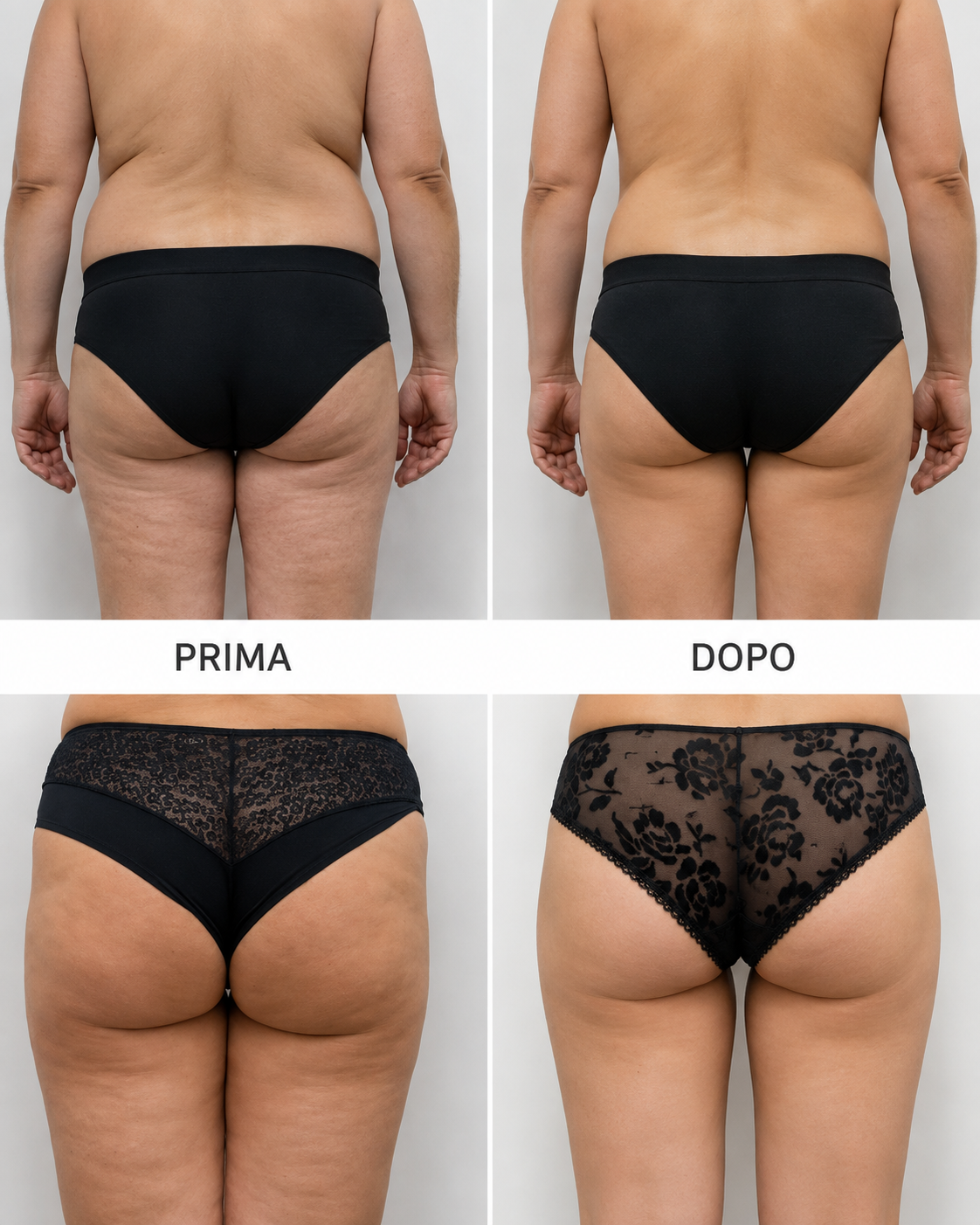 Criolipolisi glutei e fianchi — prima e dopo il trattamento