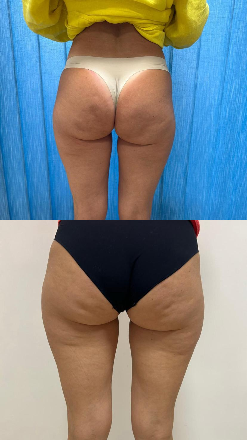 Criolipolisi glutei e cosce — pre e post trattamento