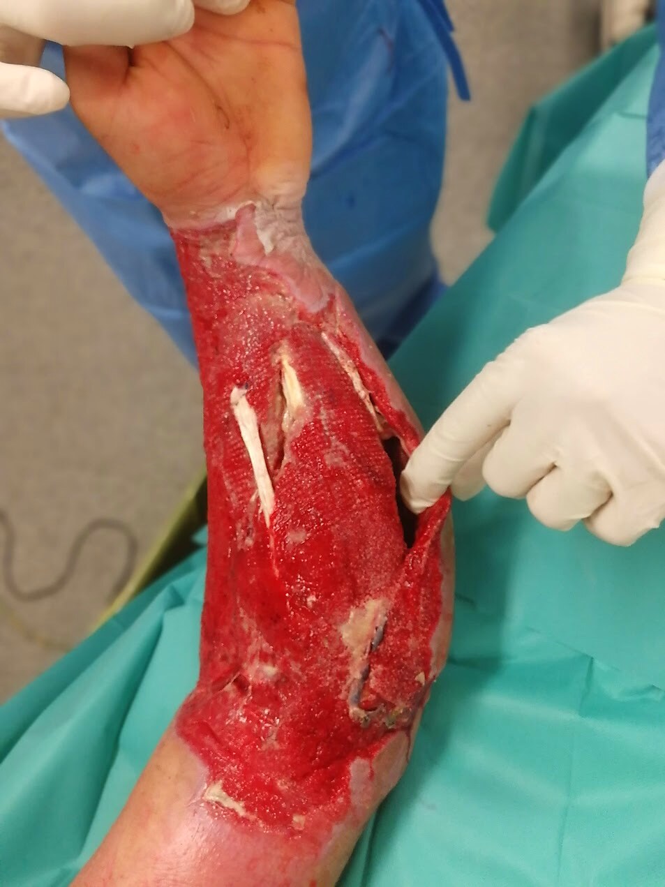 Ricostruzione arto superiore — matrice dermica e copertura tendinea