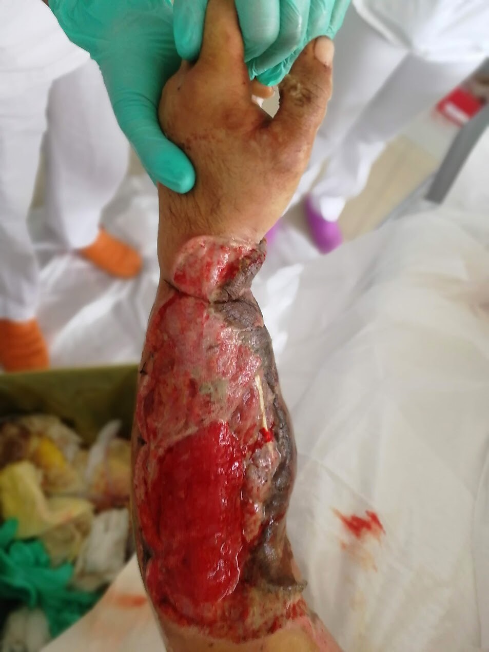 Ricostruzione arto superiore — perdita di sostanza pre-operatoria
