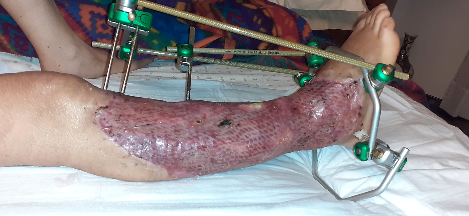 Ricostruzione arto inferiore — risultato post-operatorio con innesto cutaneo